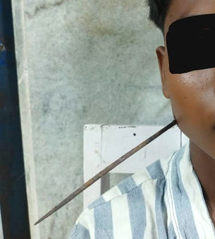 7 सेंटीमीटर तक चेहरे में घुसा औजार, घायल बालक को जान के जोखिम से बाहर लाया, ईएनटी विभाग के डॉक्टरों ने रचा कीर्तिमान....