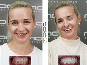 Hasta Deneyimi: Mood Dental Clinic’te Zirkonyum Kaplama Tedavisi: