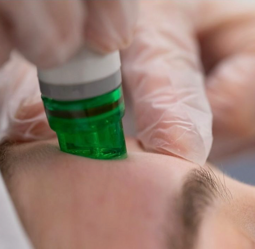 Alt Text: "Hydropeel handpiece exfoliating the skin during a 3D-HydrO2 Facial treatment." Description: A close-up of the hyd