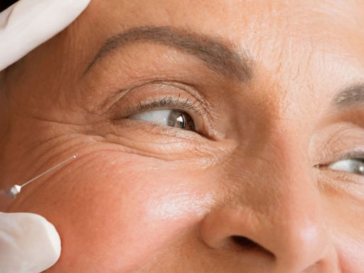 Trattamento Botox: tutto quello che devi sapere su tossina botulinica, zone trattate e tempi di recupero
