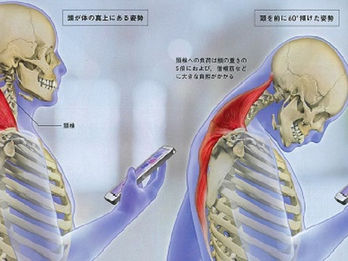 姿勢(猫背)と肩こり・腰痛・お腹たるみ