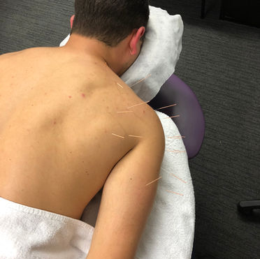 Can you exercise after Dry Needling?