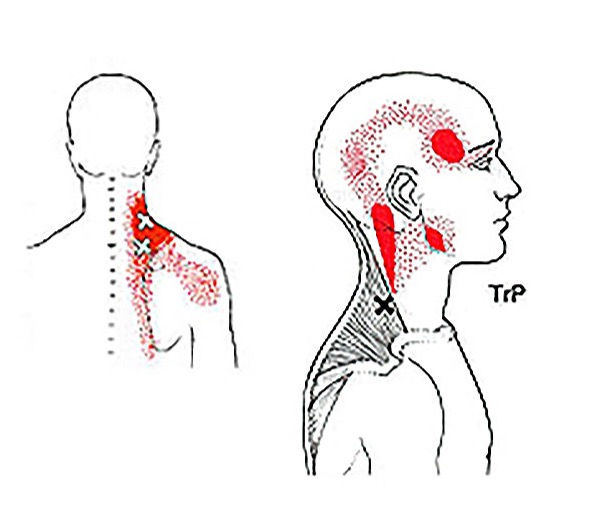 What is Trigger Point Therapy?