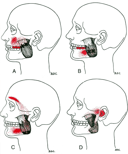 masseter.gif