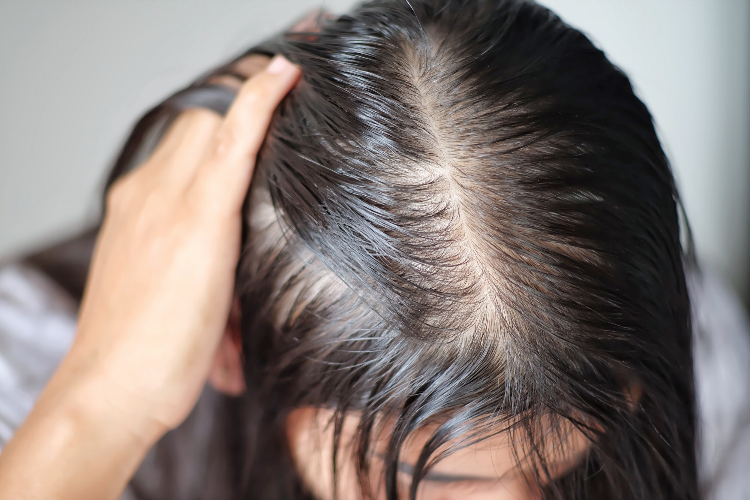Hair Loss Treatments ElevateRx Medical Aesthetics Ottawa Cosmetic Clinic