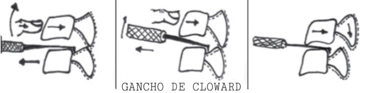 Gancho de Cloward
