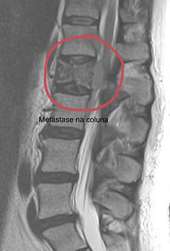 metástase na coluna vertebral