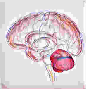 Isquemia cerebelar