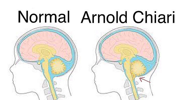 Malformação de Arnold Chiari