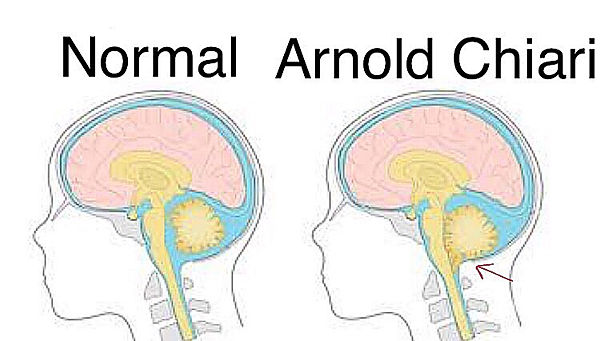 Malformação de Arnold Chiari