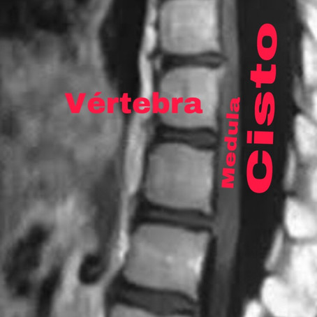 Cisto de aracnóide medular