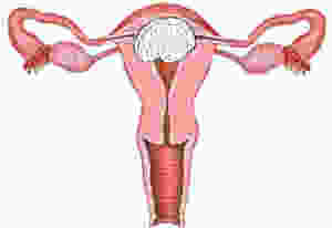 epilepsia catamenial