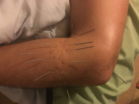 Did you know that Acupuncture can change and reduce scars increasing blood flow? Athletes beware, yo