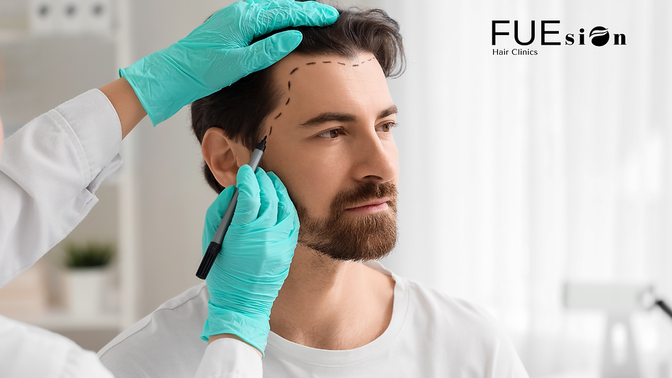 Hair Transplant Fremont CA: Experience the Future of Hair Restoration with FUEsion Hair Clinics