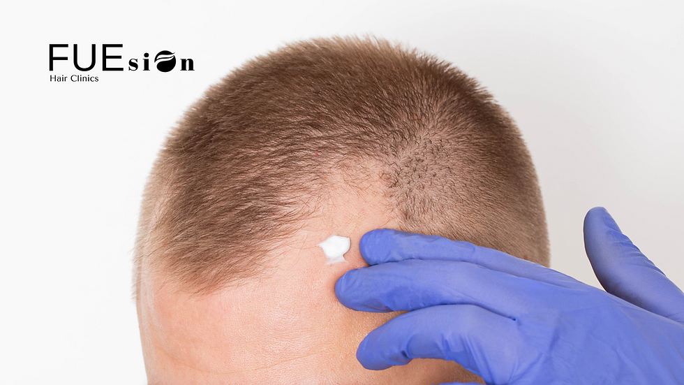 DRY SCALP AFTER HAIR TRANSPLANT: CAUSES, CARE, AND HOW FUESION HAIR CLINICS ENSURES HEALTHY HEALING