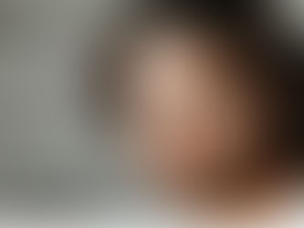 Hair Transplant Center New York: FUEsion Hair Clinics