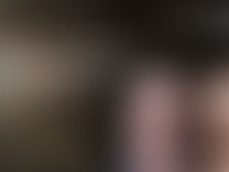 Facial Hair Transplant Brooklyn: FUEsion Hair Clinics The Ultimate Choice