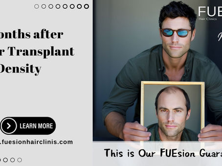 7 Months After Hair Transplant No Density – Expert Guidance from FUEsion