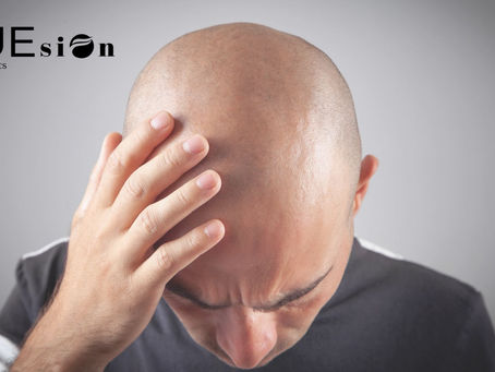 4 Months After Hair Transplant: What to Expect with FUEsion Hair Clinics