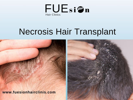 Necrosis Hair Transplant: Prevention and Solutions at FUEsion Hair Clinics