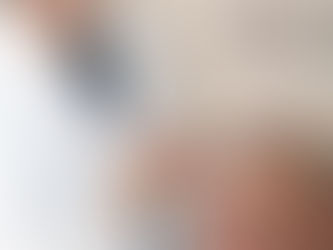 Hair Transplant After 4 Months: A Comprehensive Guide at FUEsion Hair Clinics