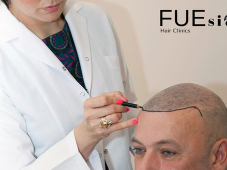 Hair Transplant After 4 Months: A Comprehensive Guide at FUEsion Hair Clinics