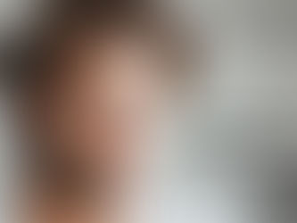 New York FUE Hair Transplant: Transform Your Look with FUEsion Hair Clinics