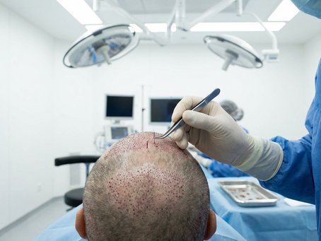 FUE Hair Transplant Houston: Advanced Hair Restoration at FUEsion Hair Clinics