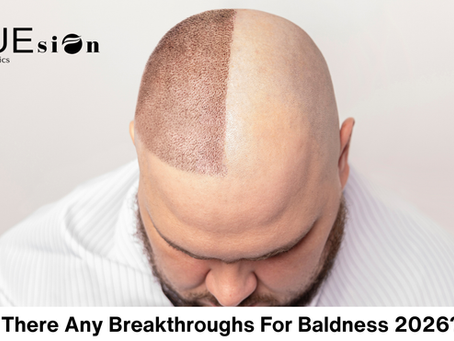 Are There Any Breakthroughs for Baldness in 2026? How FUEsion Hair Clinics Is Changing Lives