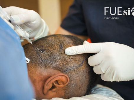 5 Months After Hair Transplant No Density – Why FUEsion Hair Clinics Is Your Best Choice