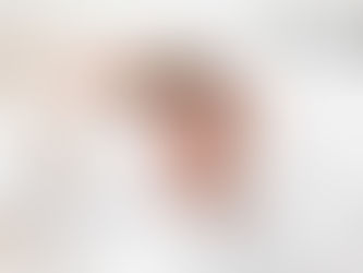 Hair Transplant 4 Months After : The FUEsion Hair Clinics Difference