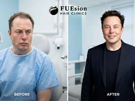 Elon Musk Hair Transplant Before and After: What His Transformation Reveals About Modern Hair Restoration