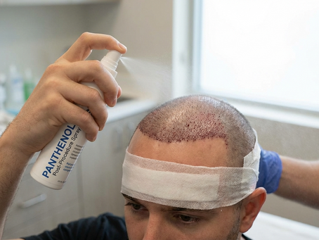 Panthenol Spray After Hair Transplant When to Start: A Complete Recovery & Aftercare Guide by FUEsion Hair Clinics