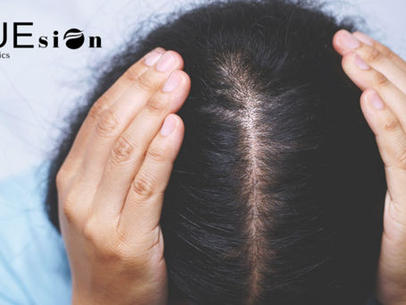 Alternatives to Hair Transplant: FUEsion Hair Clinics The Ultimate Solution
