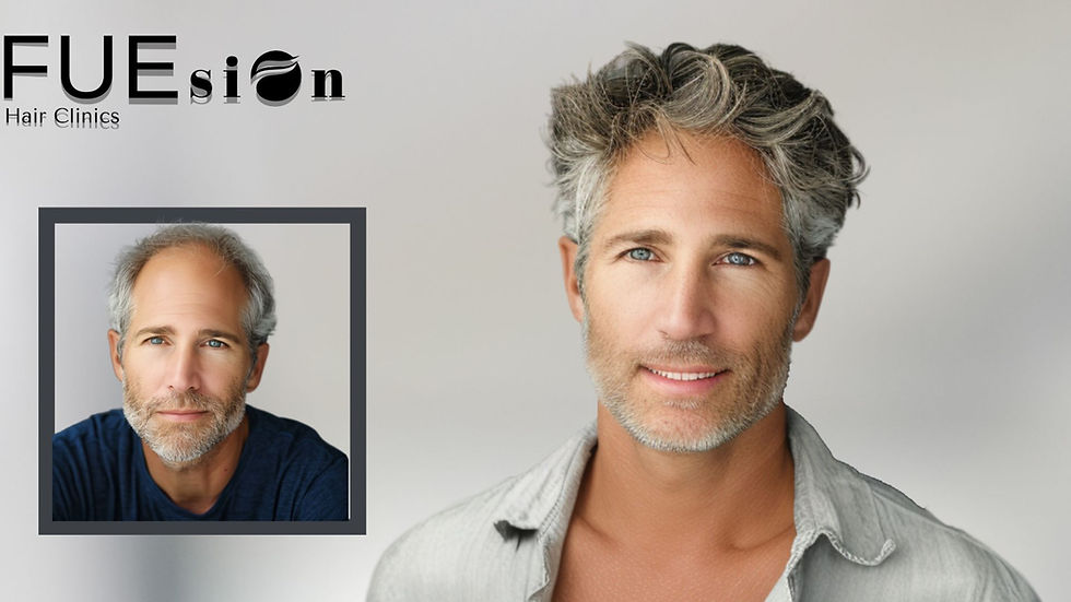 7 MONTHS AFTER HAIR TRANSPLANT NO DENSITY – WHY FUESION HAIR CLINICS OFFERS BETTER RESULTS