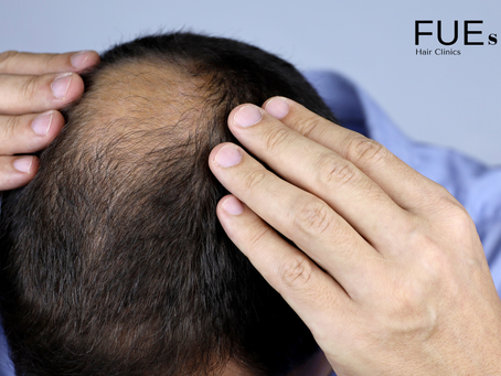 Hair Clinics and Hair Loss Treatment: A Deep Dive into FUEsion Hair Clinics