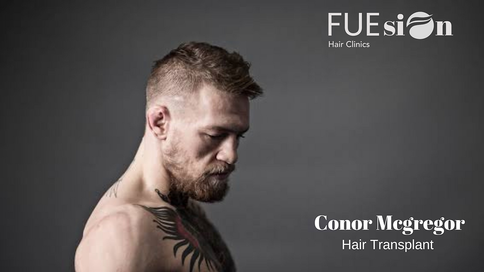 CONOR MCGREGOR HAIR TRANSPLANT: A DEEP DIVE INTO FUESION HAIR CLINICS’ ADVANCED TECHNIQUES