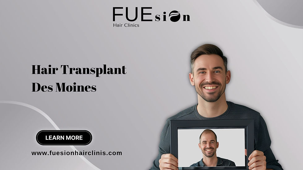 HAIR TRANSPLANT DES MOINES: DISCOVER ADVANCED SOLUTIONS WITH FUESION HAIR CLINICS