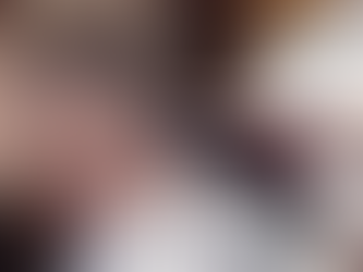 Hair Transplant No Shave: The Discreet Hair Restoration Revolution at FUEsion Hair Clinics