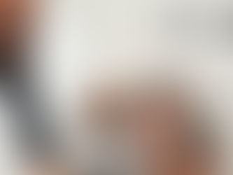 4 Months Post Hair Transplant: Comprehensive Aftercare at FUEsion Hair Clinics