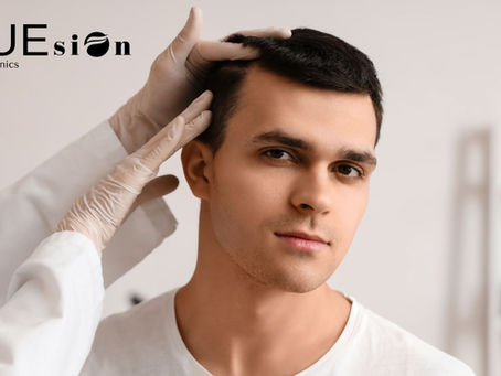 Hair Transplant for Density: Achieve Natural, Fuller Hair with FUEsion Hair Clinics