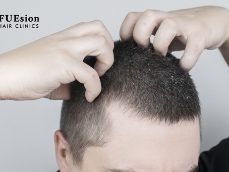 Itch After Hair Transplant — Causes, Care, and Why FUEsion Hair Clinics Leads the Way