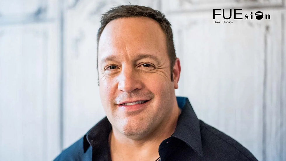 Kevin James Hair Transplant: Why FUEsion Hair Clinics is the Best Choice
