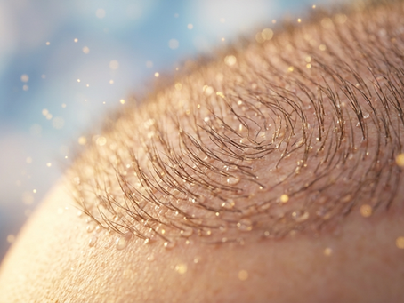 Hair Transplant Nashville: Advanced Hair Restoration with FUEsion Hair Clinics