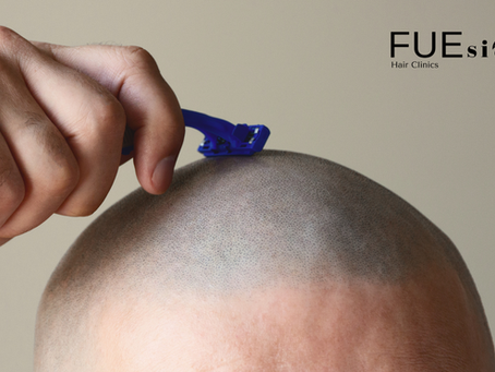 No Shave FUE Hair Transplant: The Ultimate Discreet Hair Restoration Solution at FUEsion Hair Clinics