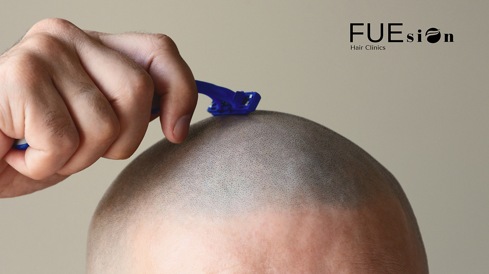 No Shave FUE Hair Transplant: The Ultimate Discreet Hair Restoration Solution at FUEsion Hair Clinics