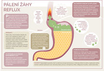 Infografika k refluxu