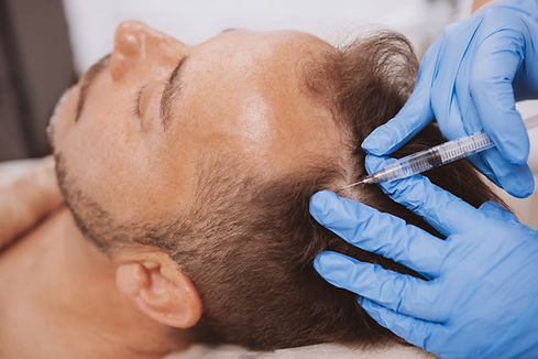Close up of a mature man receiving hairloss treatment injections in scalp by professional