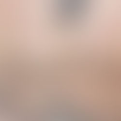 Before & After results from IPL facial