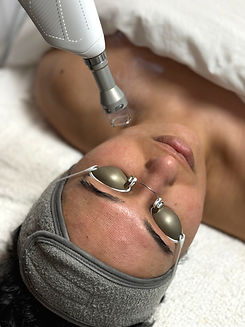 Lite Laser Facial